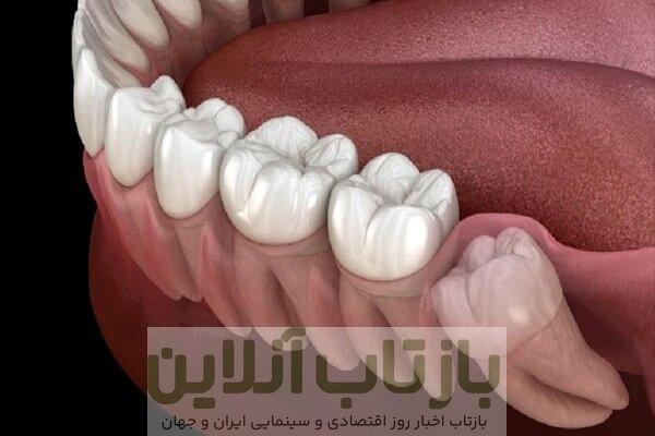 بیماری لثه خطر سکته مغزی را افزایش می دهد