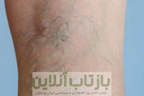 با چند عادت ساده از ابتلا به واریس پیشگیری کنیم