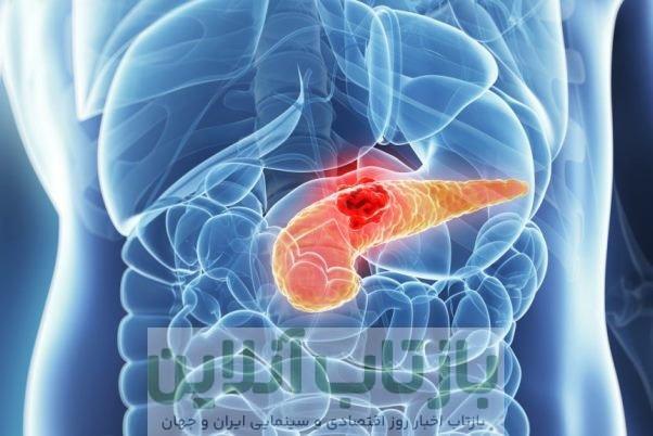 شناسایی علامت هشدار دهنده اولیه سرطان معروف به «قاتل خاموش»