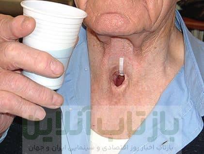 سرطان حنجره از تشخیص تا درمان > دکتر اصلان احمدی متخصص جراحی گوش و حلق و  بینی ، فلوشیپ فوق تخصصی حنجره