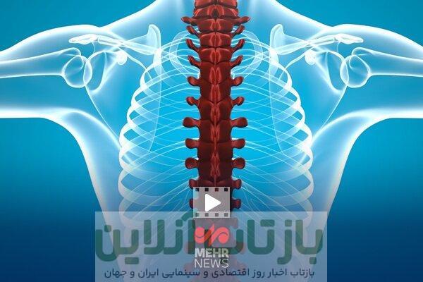 فلج اندام‌ها از عوارض شکستن قلنج توسط ماساژورها