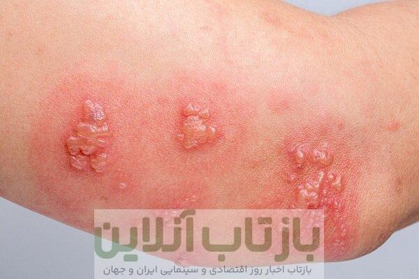 ویژگی‌های خاص واکسن زونا