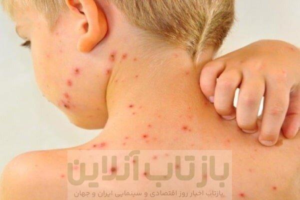 افزایش موارد ابتلا به سرخک در جهان با کاهش میزان واکسیناسیون 1 افزایش موارد ابتلا به سرخک در جهان با کاهش میزان واکسیناسیون