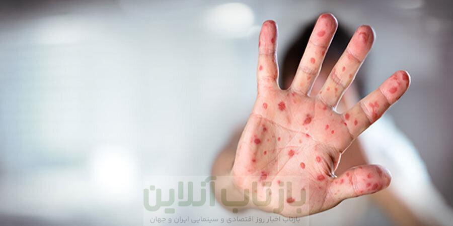 موج سرخک در بنگلادش جان ۵۰۰ کودک را گرفت 1 موج سرخک در بنگلادش جان ۵۰۰ کودک را گرفت